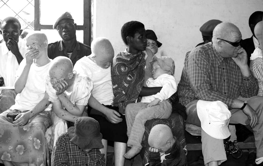 War Against Killing of Albinos in Tanzania