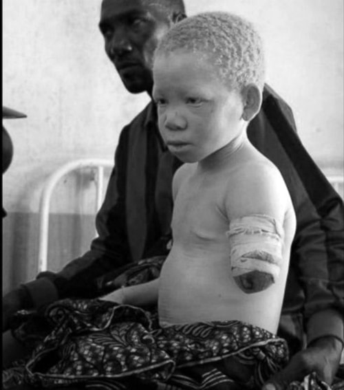 Albino child victim from witchcraft beliefs