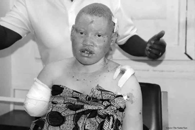 Albino teen whose hand was cut because of superstitious reasons - at the hospital